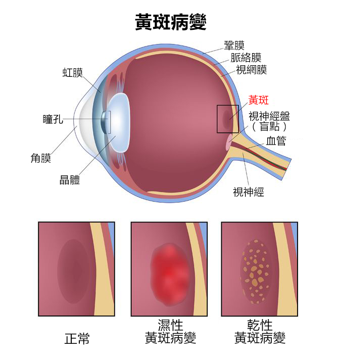 黄斑病变最新特效药研究与应用进展