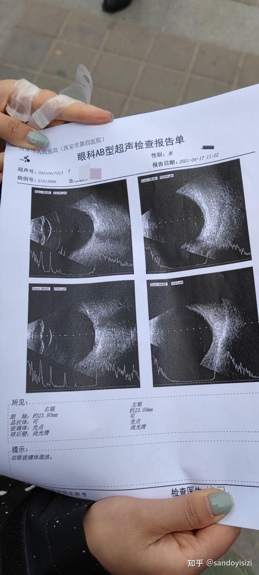 玻璃体混浊特效药突破传统，重塑视界清晰度的希望之光揭秘！