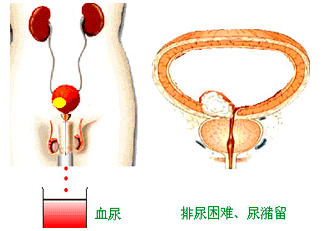 膀胱肿瘤最新治疗方法，探索创新，未来展望