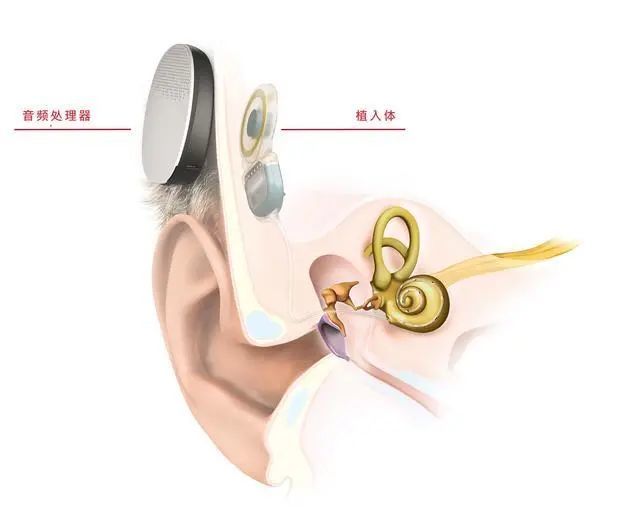 最新人工耳蜗隐形技术重塑听障者听力体验