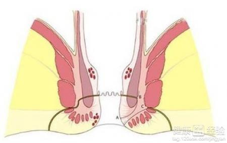肛瘘最新治疗方法概述