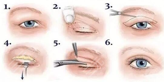 最新双眼皮技术，自然眼部魅力的塑造之道
